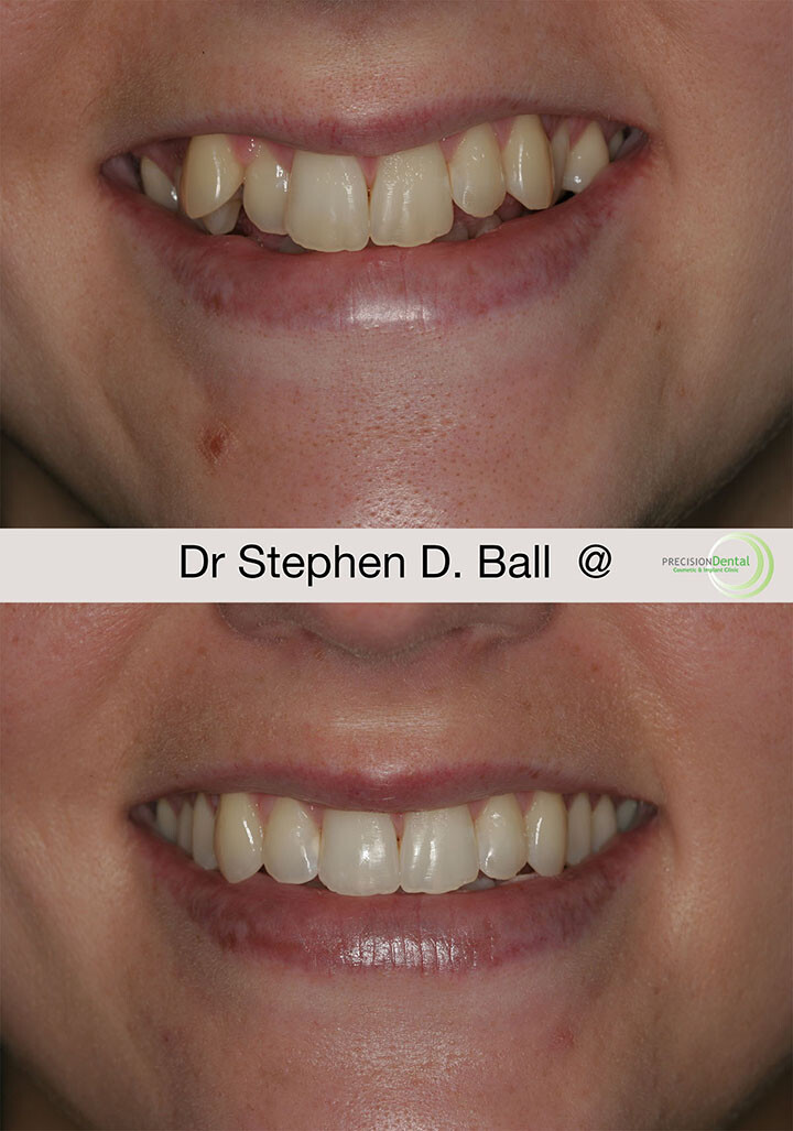 invisalign-in-sheffield-before-after-charlotte