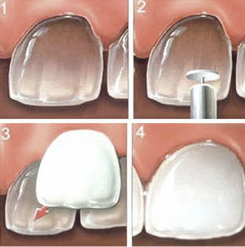 Veneers in Rotherham Recharge your smile, regain your confidence.