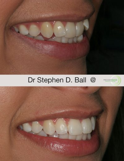invisalign-in-rotherham-before-and-after image