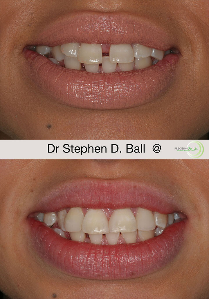 Composite Bonding in Rotherham Dental bonding to recharge your smile.