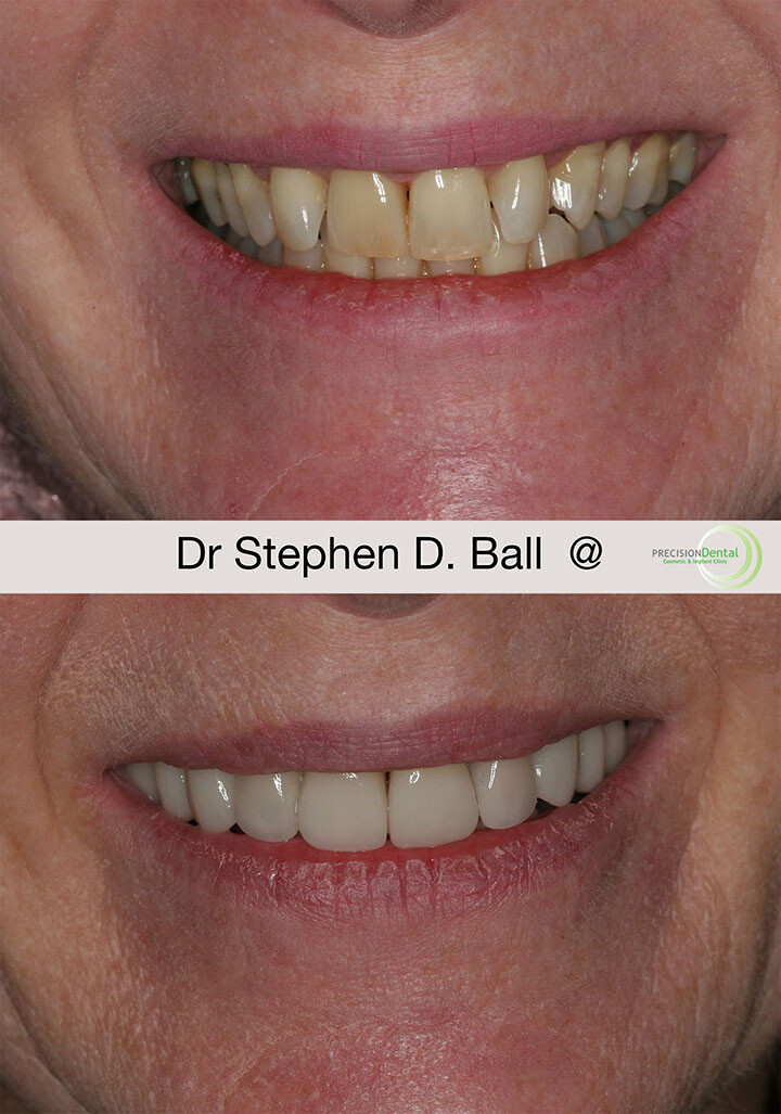Veneers in Rotherham Recharge your smile, regain your confidence.