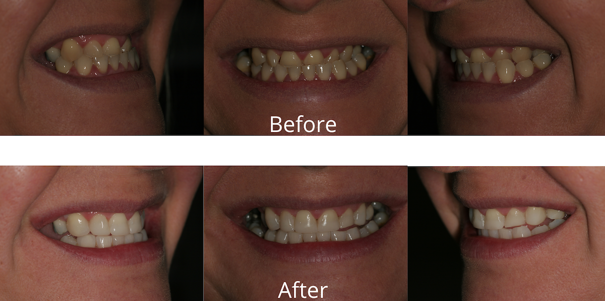 Composite Bonding in Sheffield Recharge your Smile in a day.