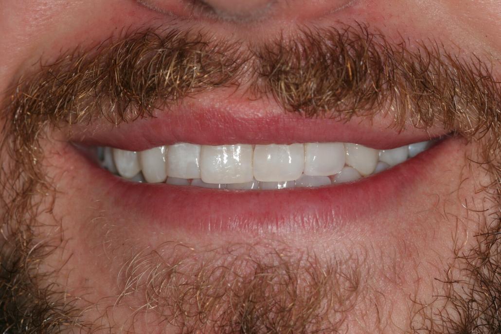 Composite Bonding in Sheffield Dental bonding to recharge your smile.