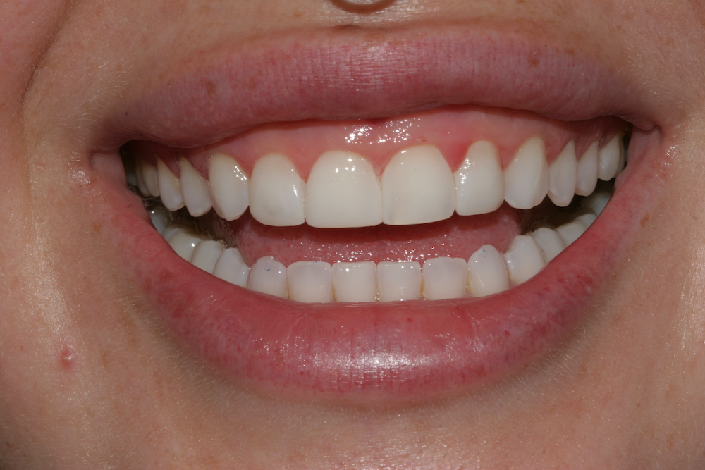 Compound Tooth Composite Bonding in Rotherham - Recharge your Smile in a day.